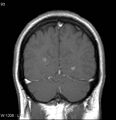 Neurosarcoidosis (Radiopaedia 10930-17204 Coronal T1 C+ 17).jpg
