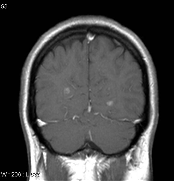 File:Neurosarcoidosis (Radiopaedia 10930-17204 Coronal T1 C+ 17).jpg
