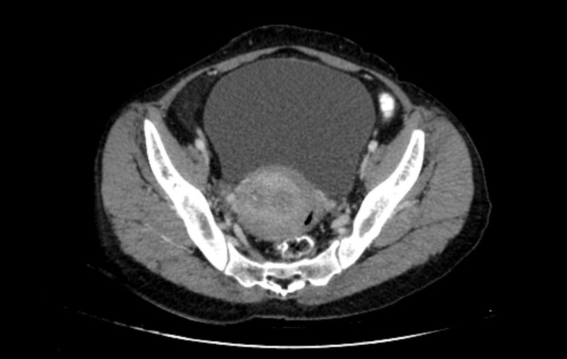 File:Non-puerperal uterine inversion (Radiopaedia 78343-91094 A 13).jpg