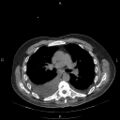Non Hodgkin lymphoma in a patient with ankylosing spondylitis (Radiopaedia 84323-99624 Axial non-contrast 16).jpg