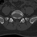 Normal CT lumbar spine (Radiopaedia 53981-60118 Axial bone window 63).jpg