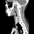 Normal CT of the neck (Radiopaedia 14575-14500 Sagittal C+ 32).jpg