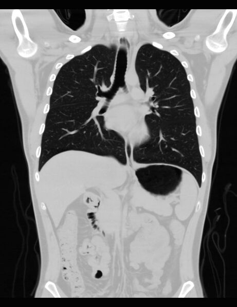 File:Normal CT virtual gastroscopy (Radiopaedia 29960-30501 F 6).jpg