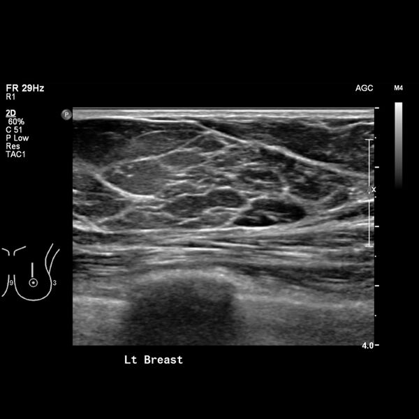File:Normal breast mammography (tomosynthesis) and ultrasound (Radiopaedia 65325-74354 Left breast 1).jpeg