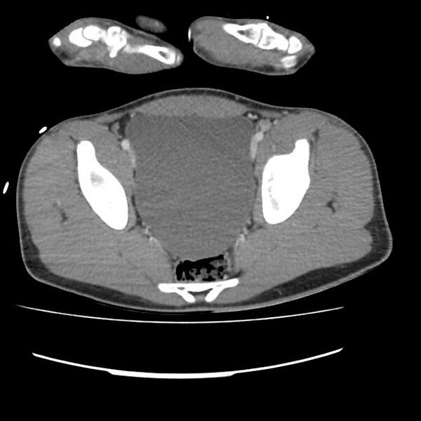 File:Normal dual-phase trauma CT chest,abdomen and pelvis (Radiopaedia 48092-52899 A 103).jpg