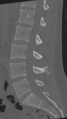Normal lumbar spine CT (Radiopaedia 46533-50986 Sagittal bone window 49).png