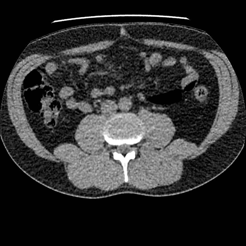 Obstructing ureteric calculus and ureteric anatomy (Radiopaedia 62730-71042 Axial non-contrast 73).jpg
