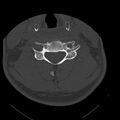 Occipital condyle fracture (Radiopaedia 31755-32691 Axial bone window 47).jpg