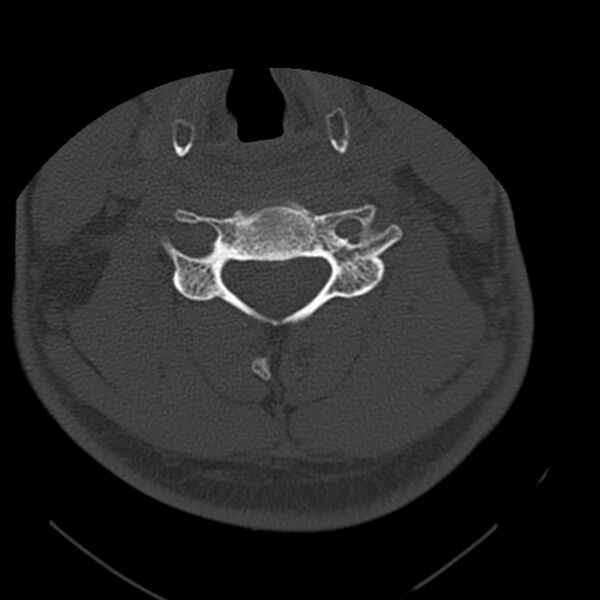 File:Occipital condyle fracture (Radiopaedia 31755-32691 Axial bone window 47).jpg
