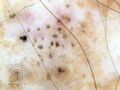 Spoke wheels in pigmented basal cell carcinoma dermoscopy (DermNet NZ doctors-dermoscopy-course-images-spoke-wheel).jpg