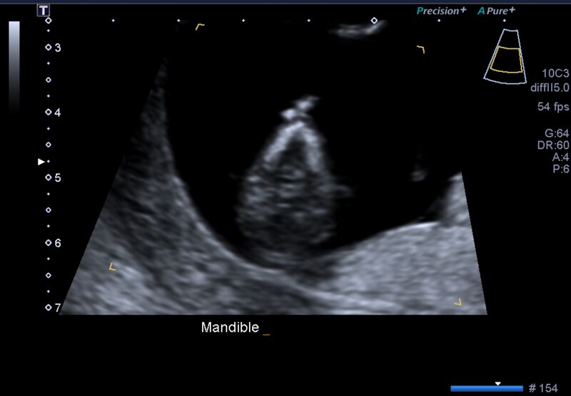 File:1st trimester nuchal-morphology ultrasound (Radiopaedia 44706-48477 General anatomy and NT 10).jpg