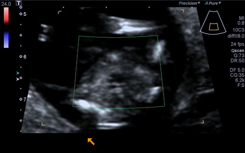 1st trimester nuchal-morphology ultrasound (Radiopaedia 44706-48477 Heart views cine with colour 176).jpg
