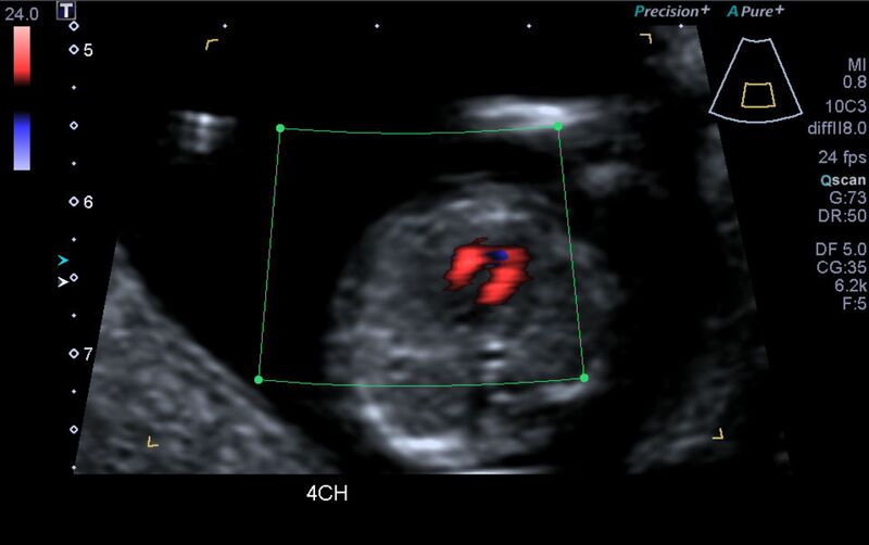 File:1st trimester nuchal-morphology ultrasound (Radiopaedia 44706-48477 Heart views cine with colour 20).jpg