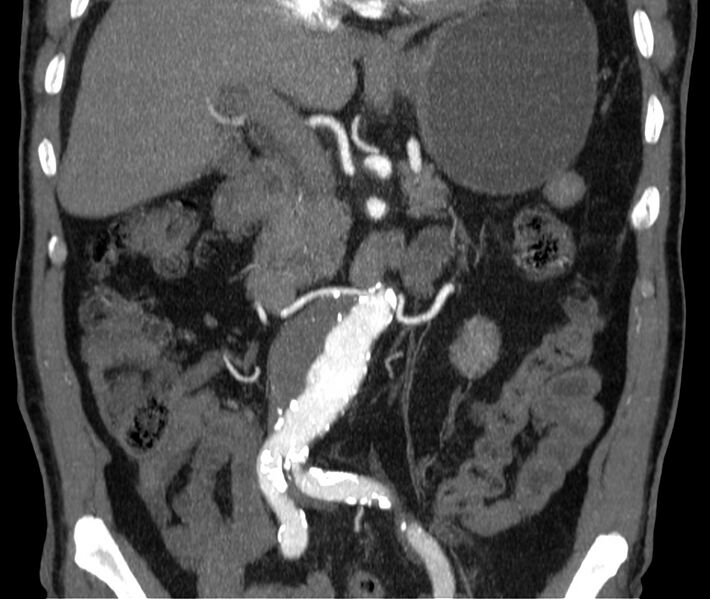File:Abdominal aortic aneurysm (Radiopaedia 22421-22458 C 18).jpg