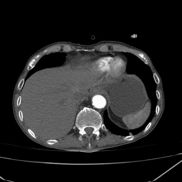 File:Abdominal aortic aneurysm (Radiopaedia 23703-23856 Axial C+ arterial phase 3).jpg