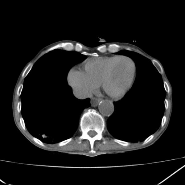 File:Abdominal aortic aneurysm (Radiopaedia 23703-23856 Axial non-contrast 1).jpg