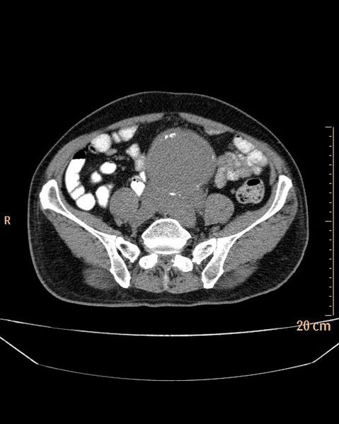 File:Abdominal aortic aneurysm (Radiopaedia 25985-26121 Axial non-contrast 21).jpg