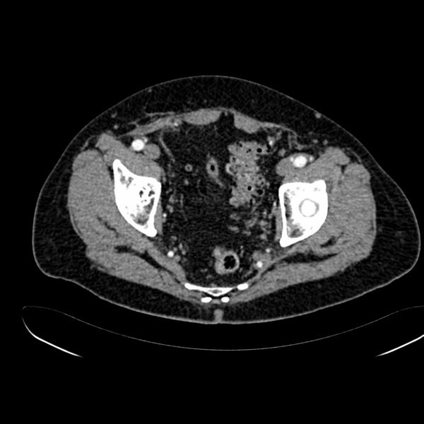 File:Abdominal aortic aneurysm (Radiopaedia 75131-86203 Axial C+ arterial phase 42).jpg
