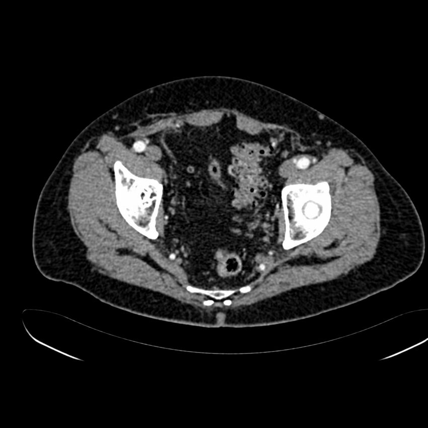 Abdominal aortic aneurysm (Radiopaedia 75131-86203 Axial C+ arterial phase 42).jpg