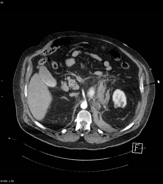 File:Abdominal aortic aneurysm with intramural hematoma then rupture (Radiopaedia 50278-55632 Axial C+ arterial phase 58).jpg