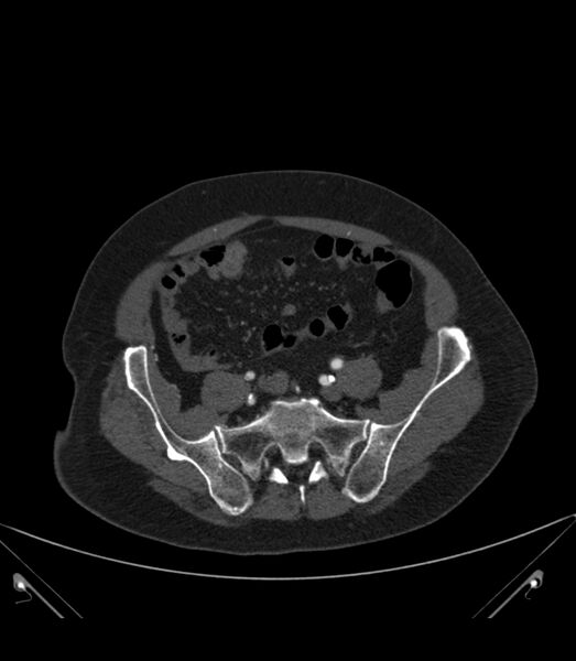 File:Abdominal aortic aneurysm with thrombus fissuration (Radiopaedia 46218-50618 Axial C+ arterial phase 32).jpg