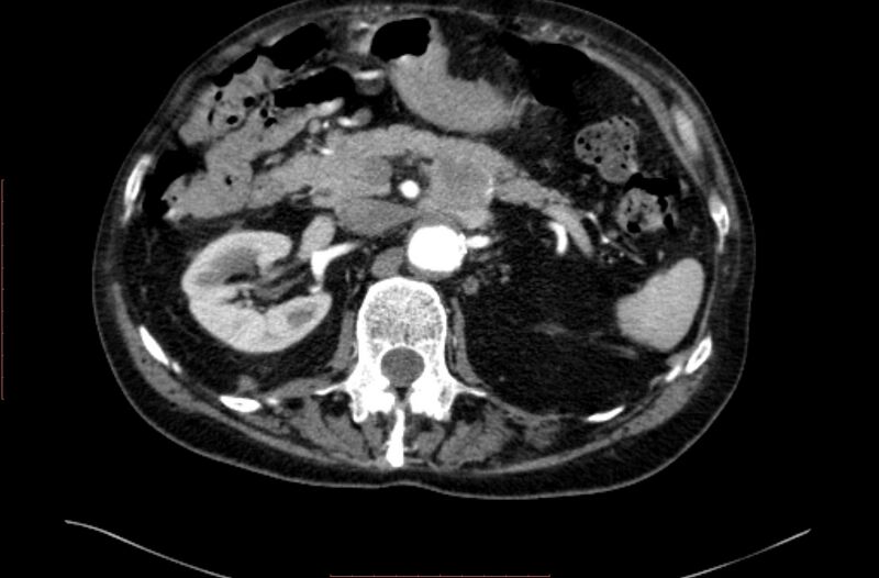 File:Abdominal aortic interposition tube graft and aneurysm thrombosis (Radiopaedia 71438-81857 Axial C+ arterial phase 38).jpg