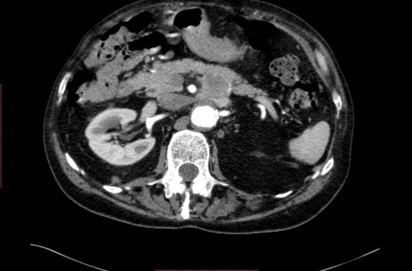 Abdominal aortic interposition tube graft and aneurysm thrombosis (Radiopaedia 71438-81857 Axial C+ arterial phase 38).jpg