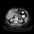 Abdominal wall recurrence after colorectal resection for cancer (Radiopaedia 23444-23523 Axial C+ portal venous phase 8).jpg