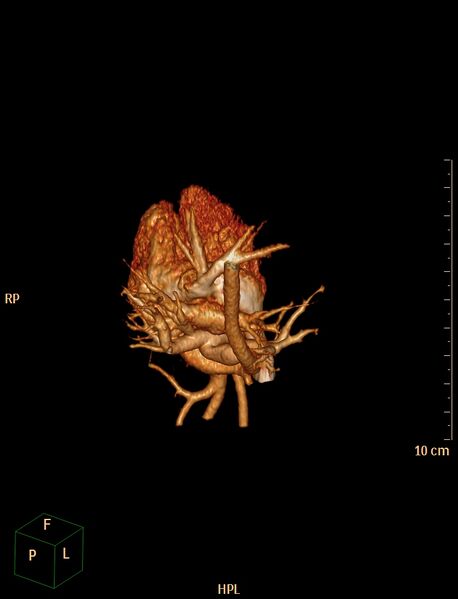 File:Aberrant left pulmonary artery (pulmonary sling) (Radiopaedia 42323-45435 3D reconstruction C+ CTPA 15).jpg