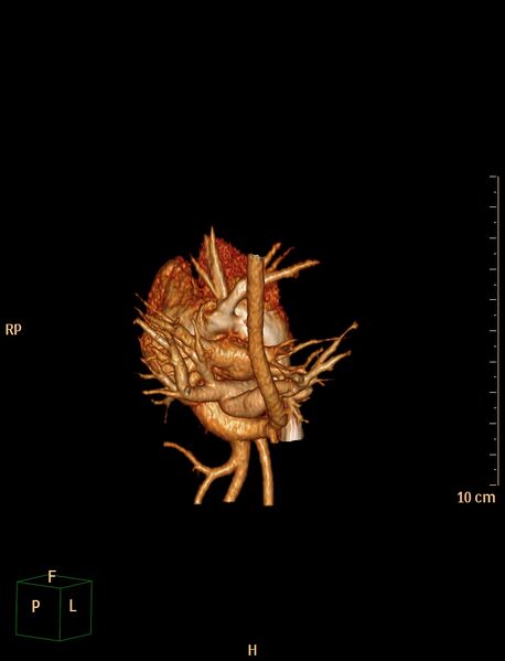 File:Aberrant left pulmonary artery (pulmonary sling) (Radiopaedia 42323-45435 3D reconstruction C+ CTPA 17).jpg