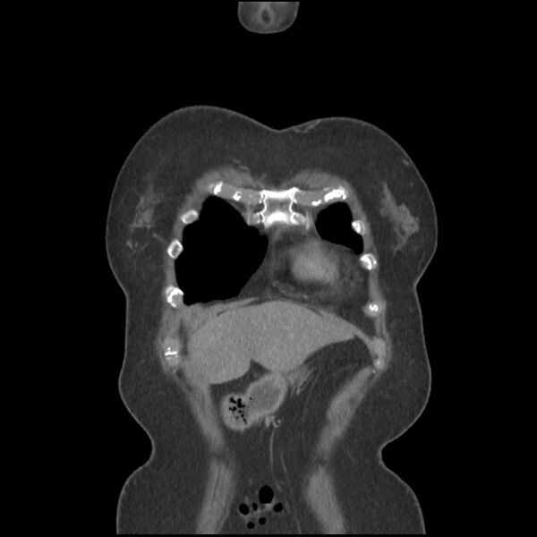 File:Aberrant right subclavian and left vertebral arteries (Radiopaedia 43467-46847 Coronal C+ portal venous phase 10).jpg