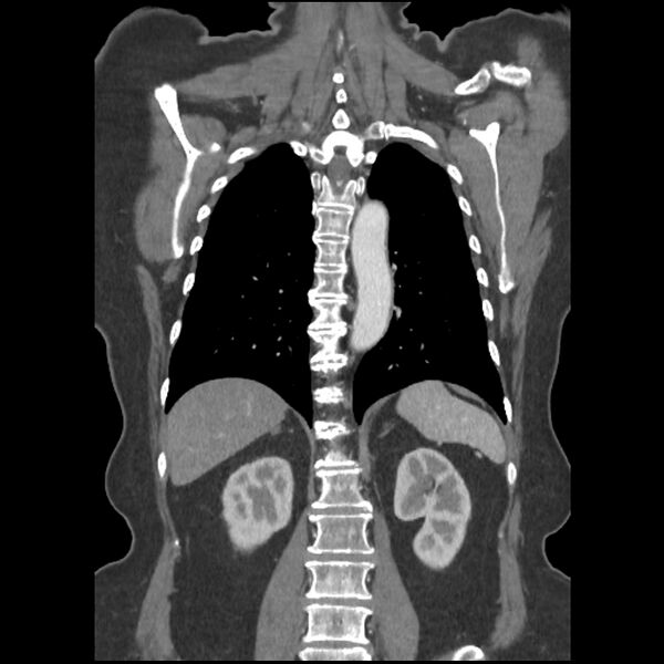 File:Aberrant right subclavian and left vertebral arteries (Radiopaedia 43467-46847 Coronal C+ portal venous phase 63).jpg