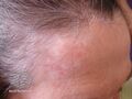 Actinic Keratoses treated with imiquimod (DermNet NZ lesions-ak-imiquimod-3729).jpg