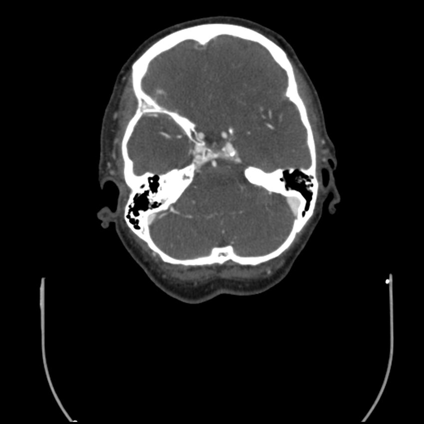 Acute M1 occlusion with ischemic penumbra (CT perfusion) (Radiopaedia 71897-82344 Axial C+ arterial phase thins 108).jpg