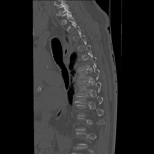 File:Acute and chronic vertebral compression fractures (Radiopaedia 31608-32494 Sagittal bone window 5).jpg