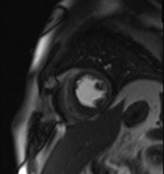File:Acute anteroseptal myocardial infarction (Radiopaedia 68409-77945 Short axis (mid ventricular) Perfusion 11).jpg
