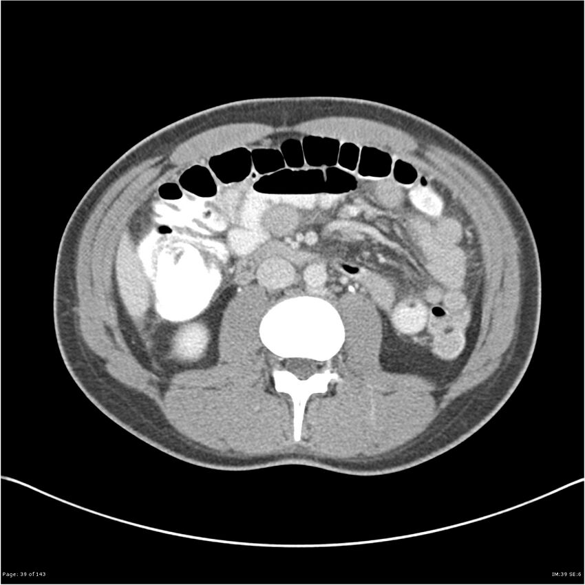 Acute appendicitis (Radiopaedia 25364-25615 B 29).jpg