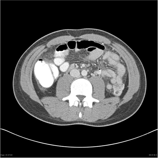 File:Acute appendicitis (Radiopaedia 25364-25615 B 33).jpg