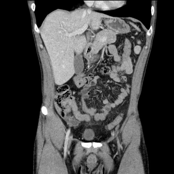 File:Acute appendicitis (Radiopaedia 27049-27227 Coronal C+ portal venous phase 18).jpg