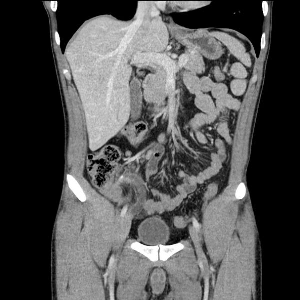 File:Acute appendicitis (Radiopaedia 27049-27227 Coronal C+ portal venous phase 21).jpg
