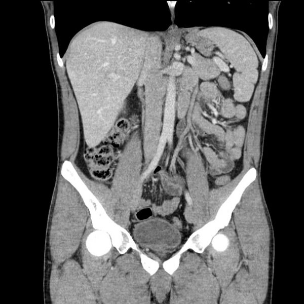 File:Acute appendicitis (Radiopaedia 27049-27227 Coronal C+ portal venous phase 27).jpg
