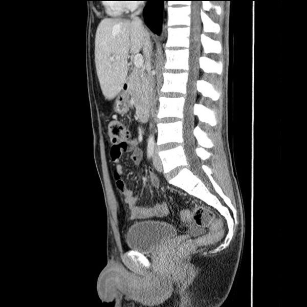 File:Acute appendicitis (Radiopaedia 27049-27227 Sagittal C+ portal venous phase 40).jpg