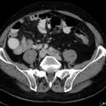 Acute appendicitis arising from a malrotated cecum (Radiopaedia 19970-19997 Axial C+ portal venous phase 28).jpg