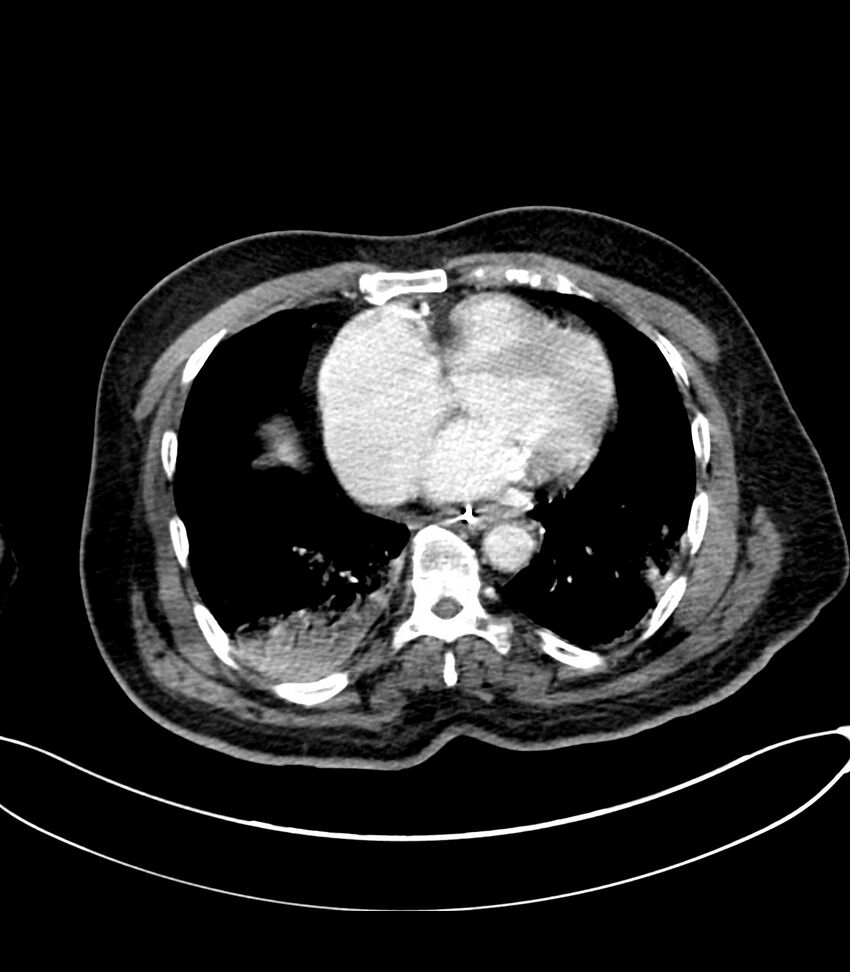 Acute arterial mesenteric ischemia (Radiopaedia 78238-90828 Axial C+ portal venous phase 11).jpg