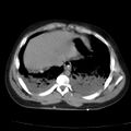 Acute aspiration pneumonitis (Radiopaedia 33605-34703 Axial non-contrast 66).jpg