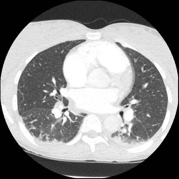 File:Acute chest syndrome - sickle cell disease (Radiopaedia 42375-45499 Axial lung window 100).jpg