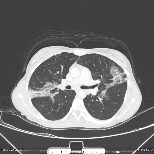 File:Acute eosinophilic pneumonia (Radiopaedia 48211-53073 Axial lung window 37).jpg