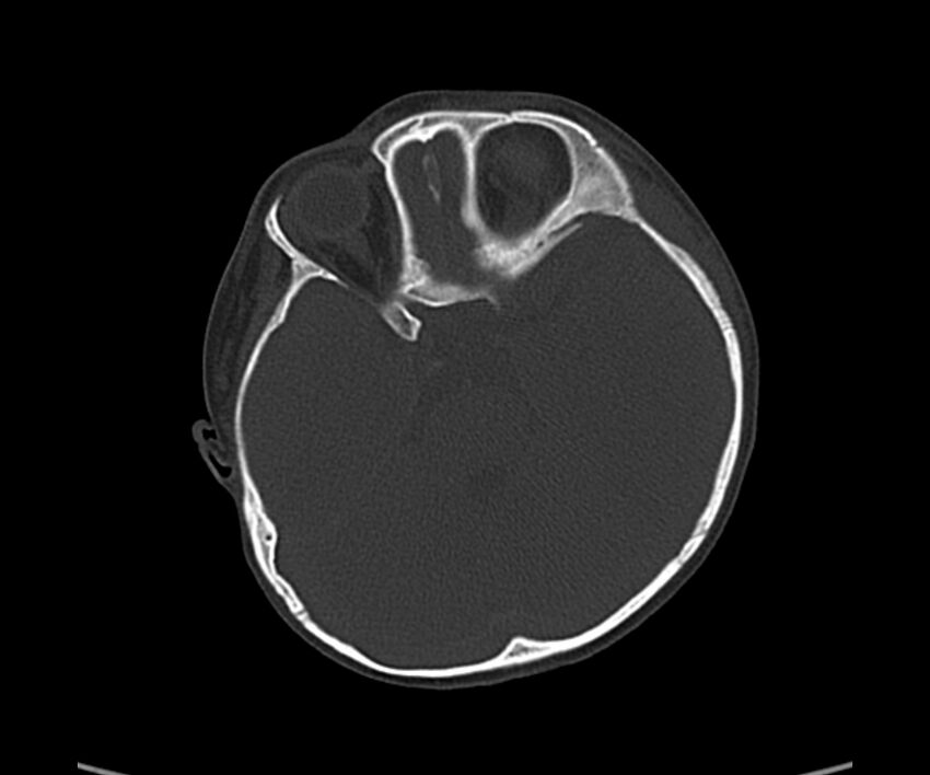 Acute hemorrhagic contusion (Radiopaedia 63660-72336 Axial bone window 24).jpg
