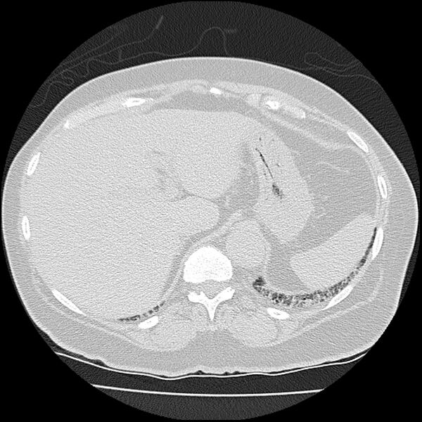File:Acute interstitial pneumonitis (Radiopaedia 45404-49452 Axial lung window 85).jpg