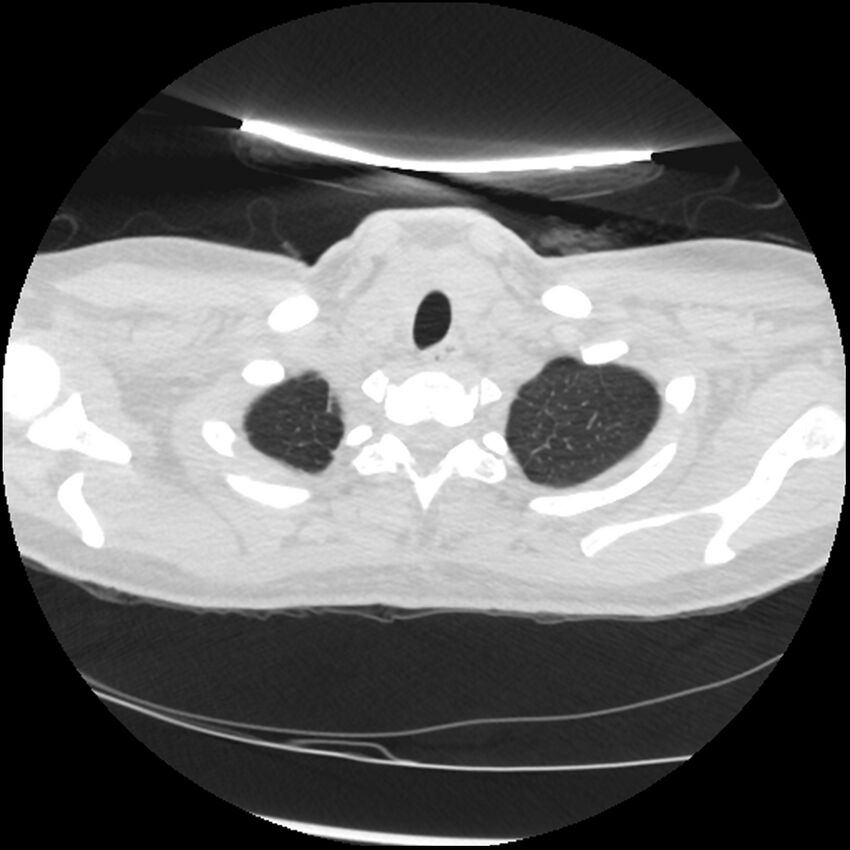 Acute lupus nephritis (Radiopaedia 45832-50107 Axial lung window 7).jpg